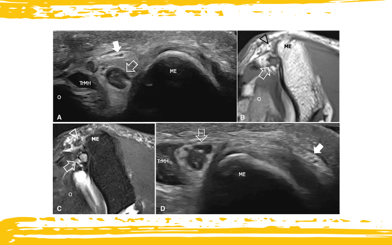 4. Nervio cutaneo medial antebrazo tempo formacion.png